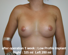 plastic-surgery-breast-augmentation